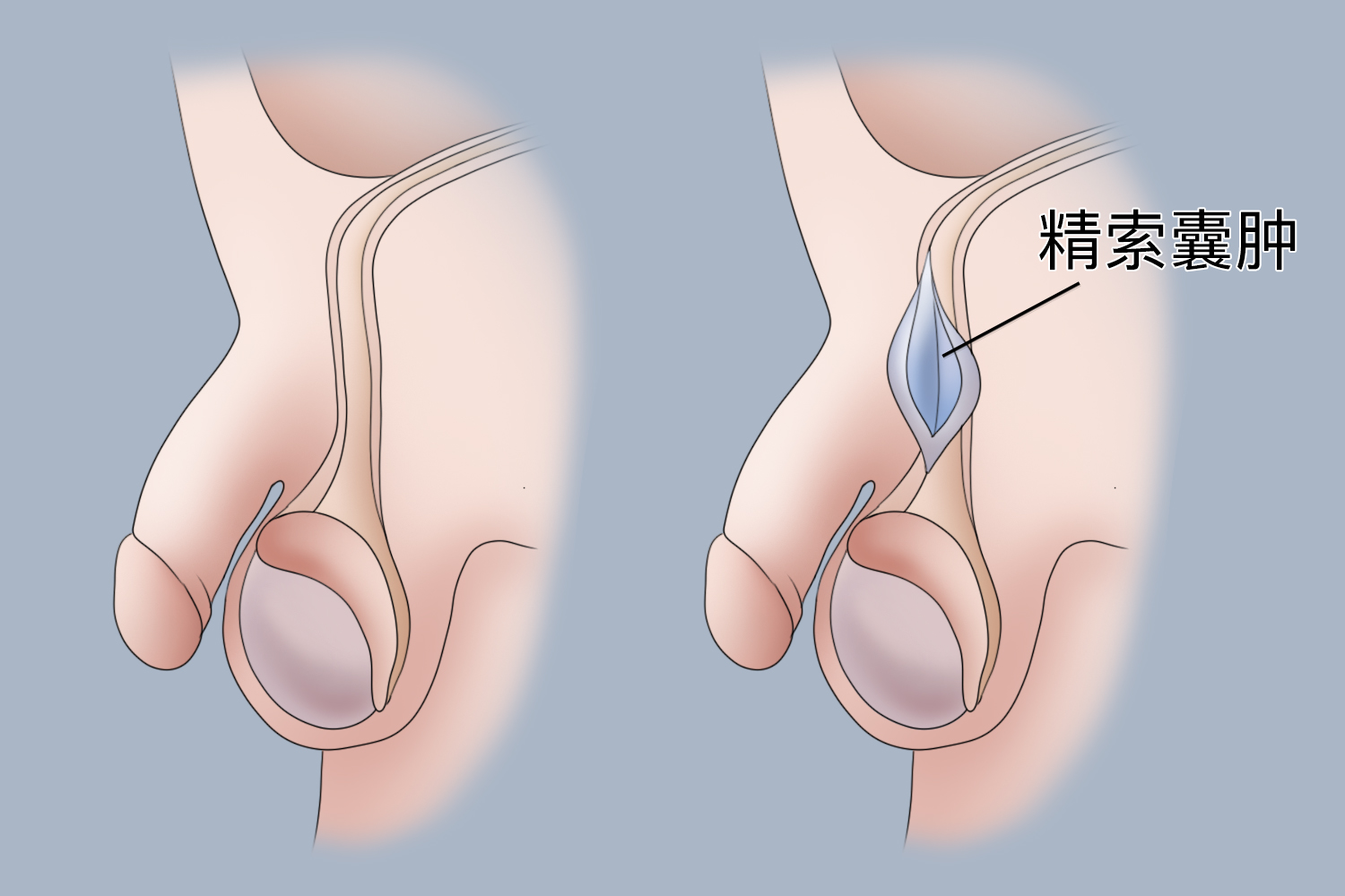 精索图片正常图片图片