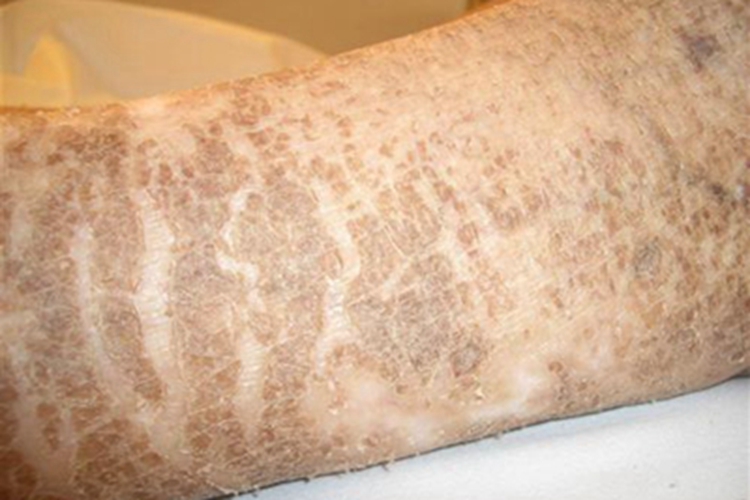 X连锁鱼鳞病结痂图 X连锁鱼鳞病结痂图