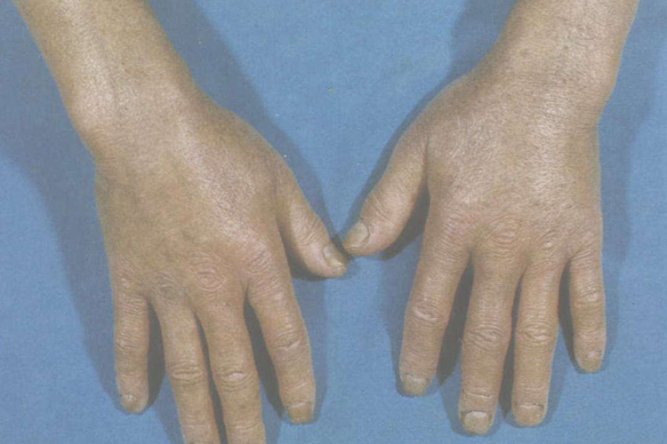 系统性硬化症皮肤硬化期图