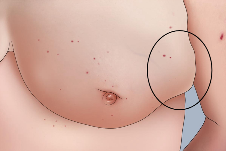 乳腺癌乳房硬块图 乳腺癌乳房硬块图