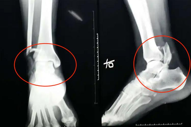 脚踝粉碎性骨折X线检查图