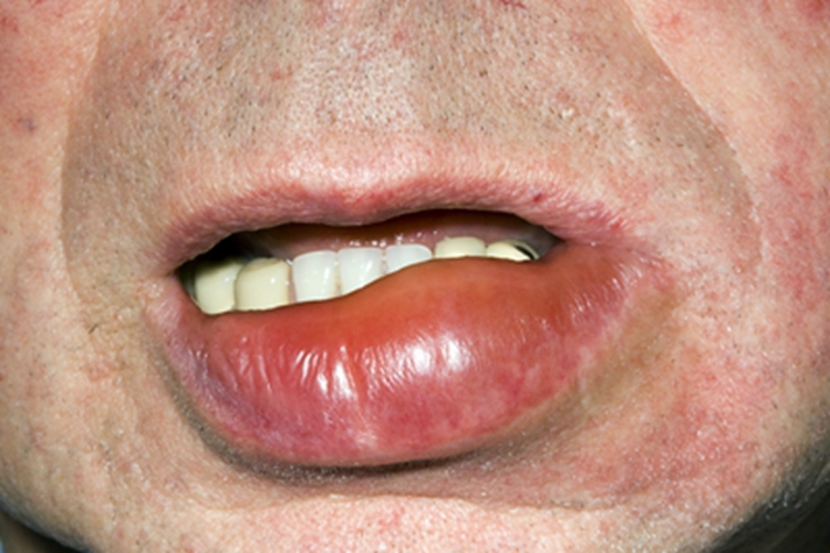 接触性唇炎嘴唇明显水肿图 接触性唇炎嘴唇明显水肿图