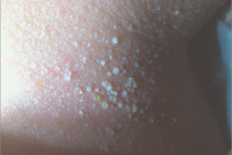 白痱后颈症状图 白痱后颈症状图