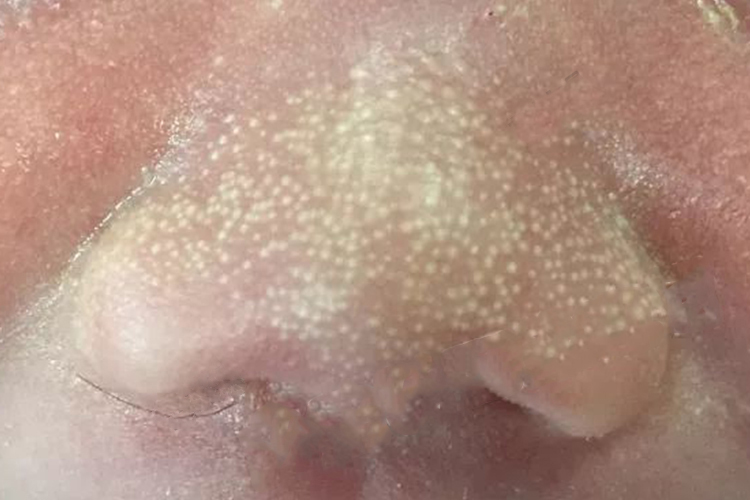 早熟性皮脂腺增生图