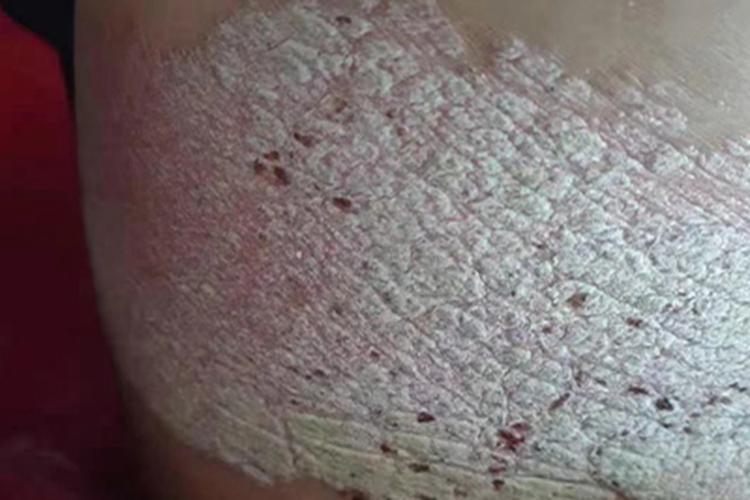 寻常型银屑病后背有银白色鳞屑图