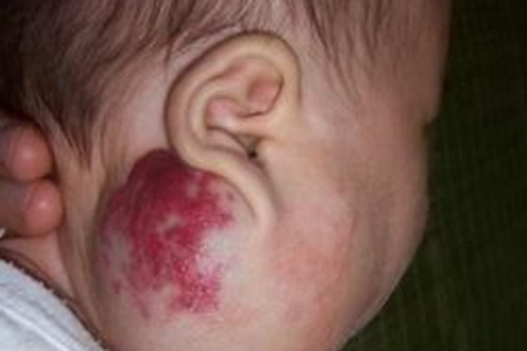 海绵状血管瘤耳周症状图