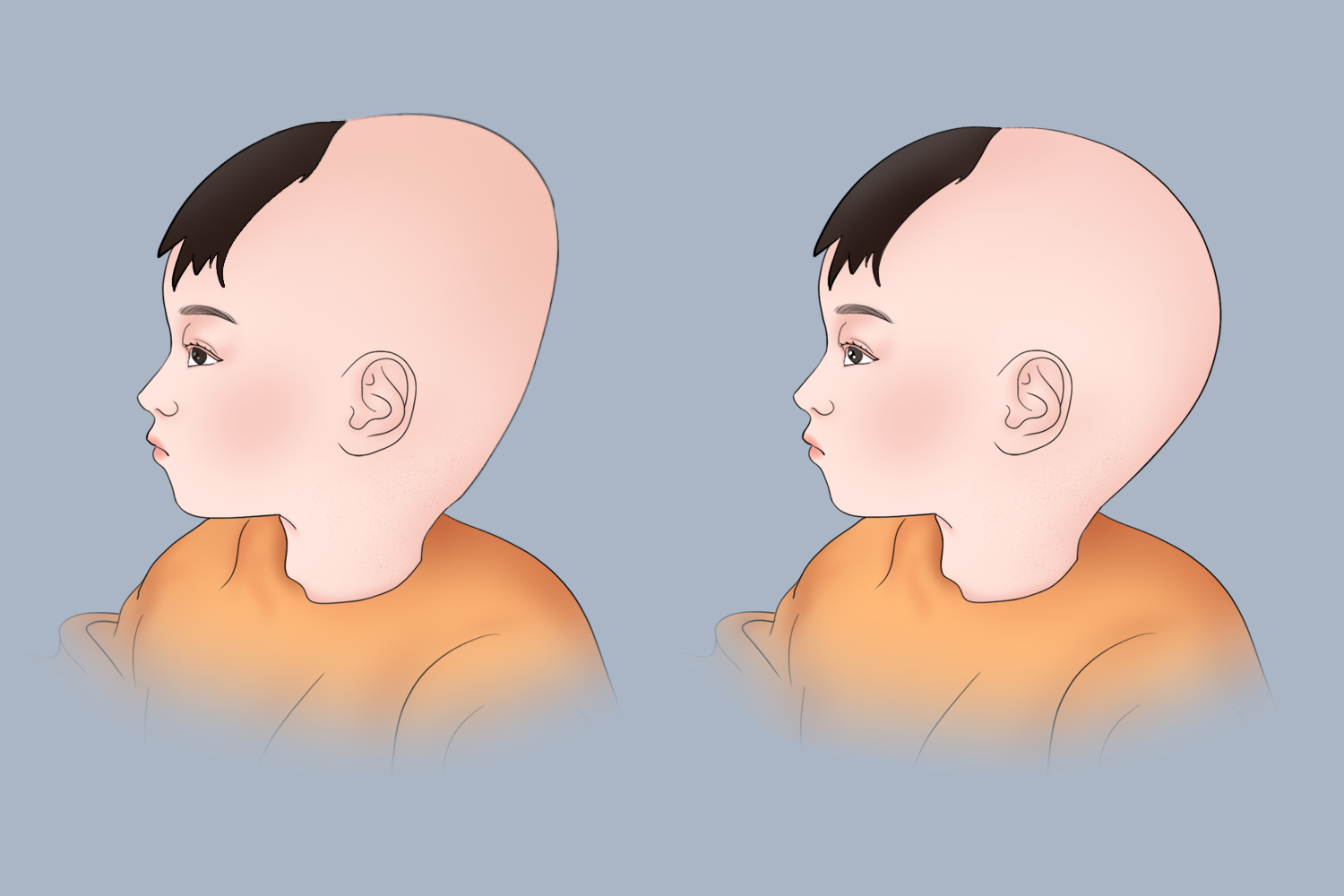 新生儿扁头和圆头区别图