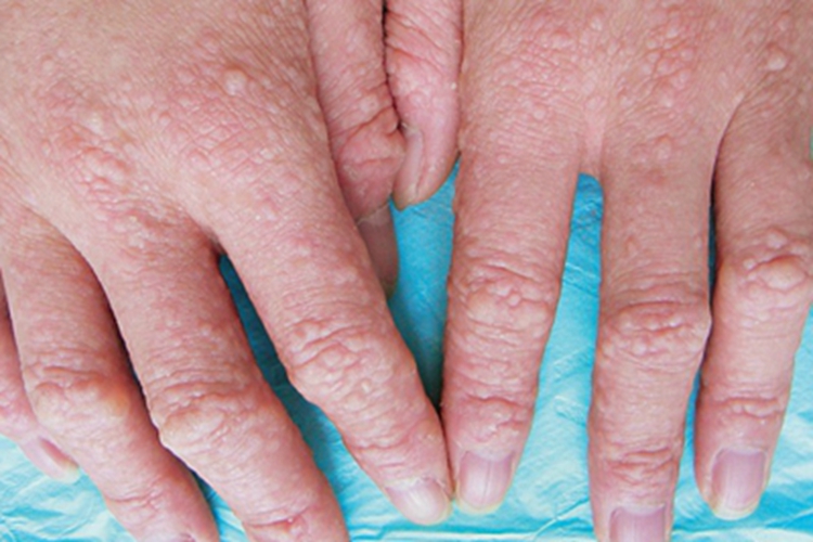 砷角化病硬疙瘩图