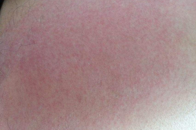 皮肤过敏红斑图