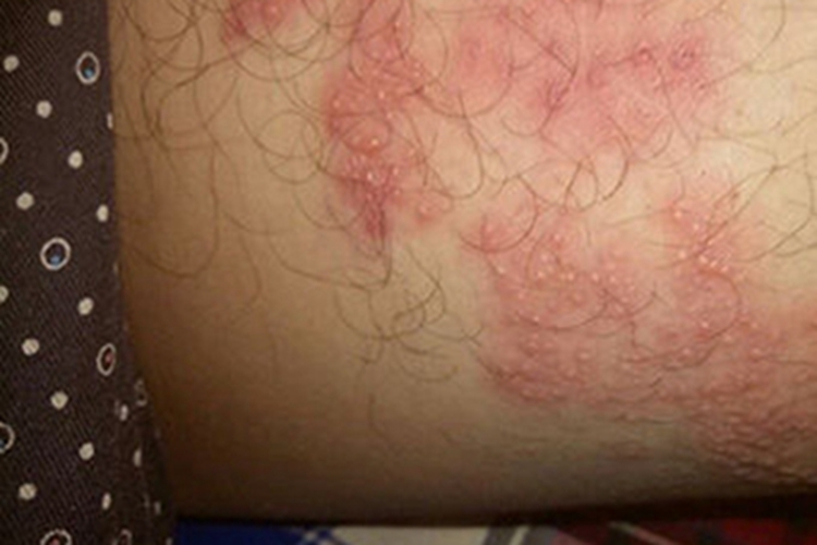 急性湿疹大腿斑图