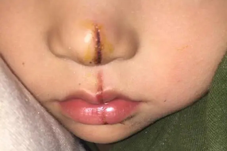 鼻子上伤口结黑痂图