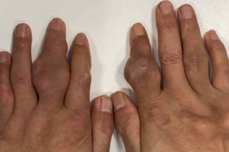 痛风手部变形图