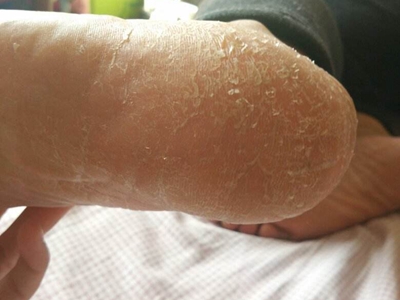更年期角皮症脚后跟皮屑不断脱落图