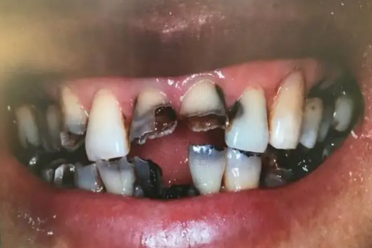 龋齿豁牙图