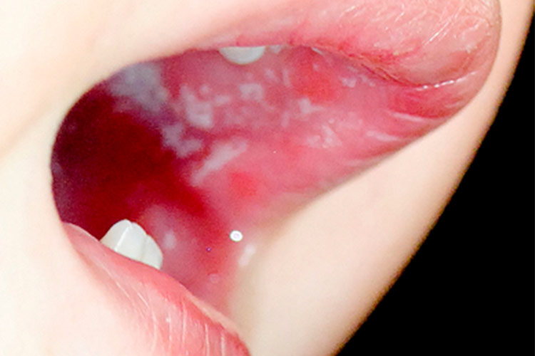 擦除白膜黏膜出血图