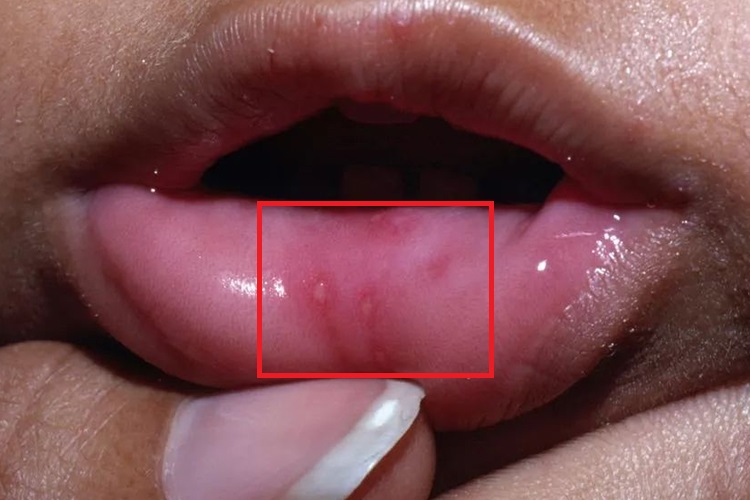 轻型复发性阿弗他溃疡图