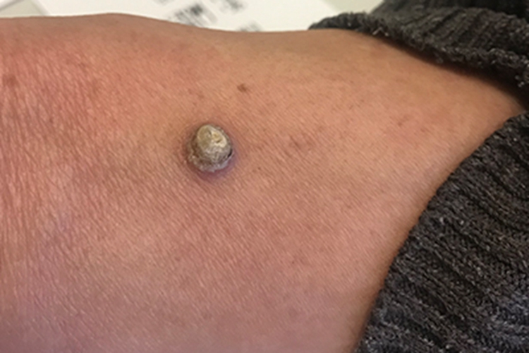 寻常疣胳膊有一个圆疙瘩图 寻常疣胳膊有一个圆疙瘩图