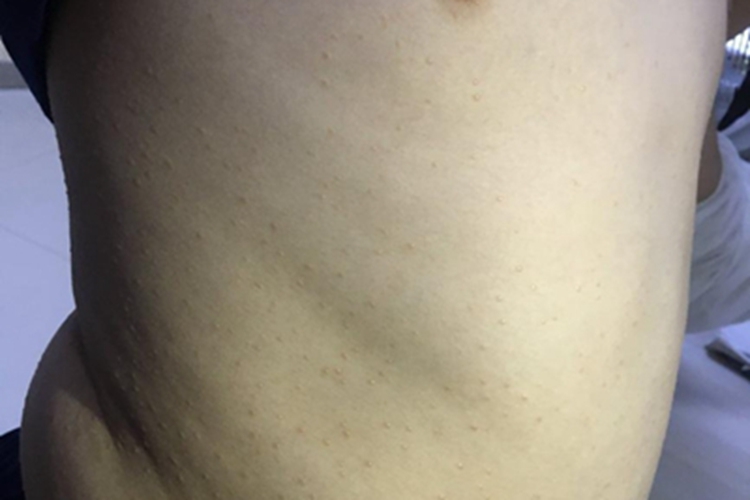 光泽苔藓右腹症状图
