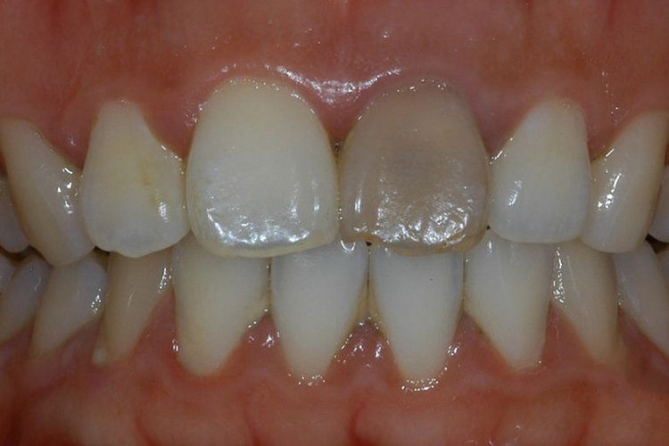 死牙外观图 死牙外观图