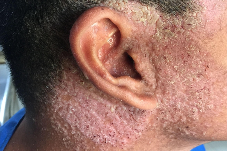 皮肤垢着病耳后症状图