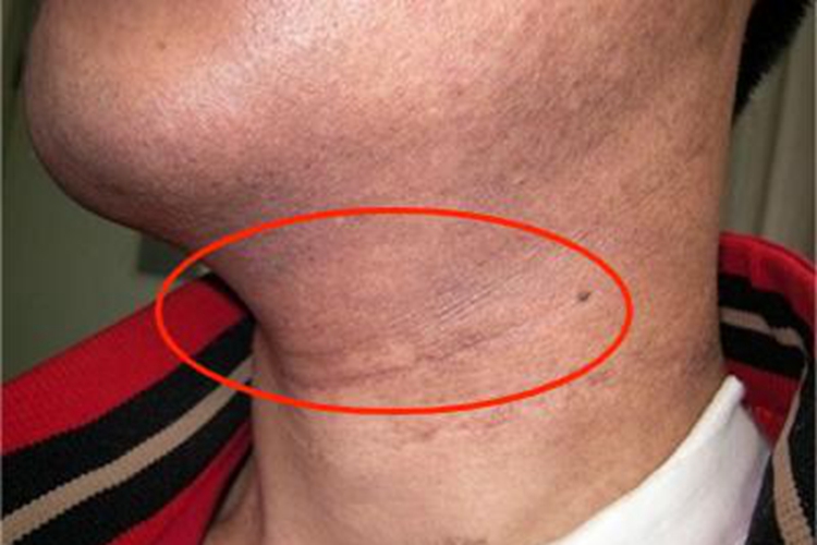 焦油黑变病颈部症状图 焦油黑变病颈部症状图