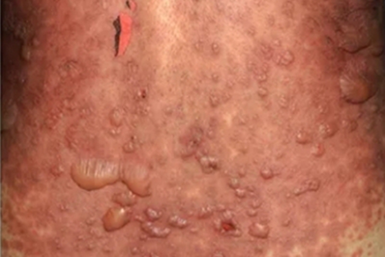 大疱性表皮松解症背部水疱图