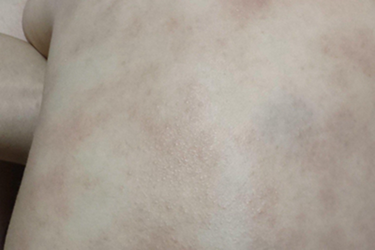 干性湿疹背部皮肤粗糙图