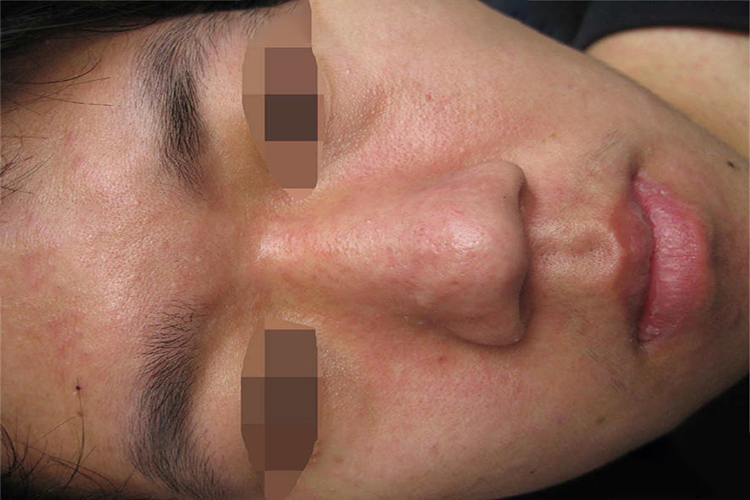 弥漫充血性针尖大小的丘疹图