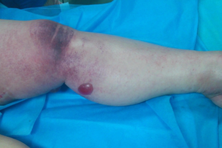 下肢深静脉血栓形成小腿水疱图