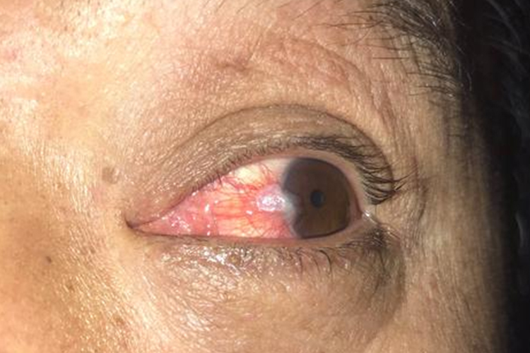 轻微翼状胬肉图