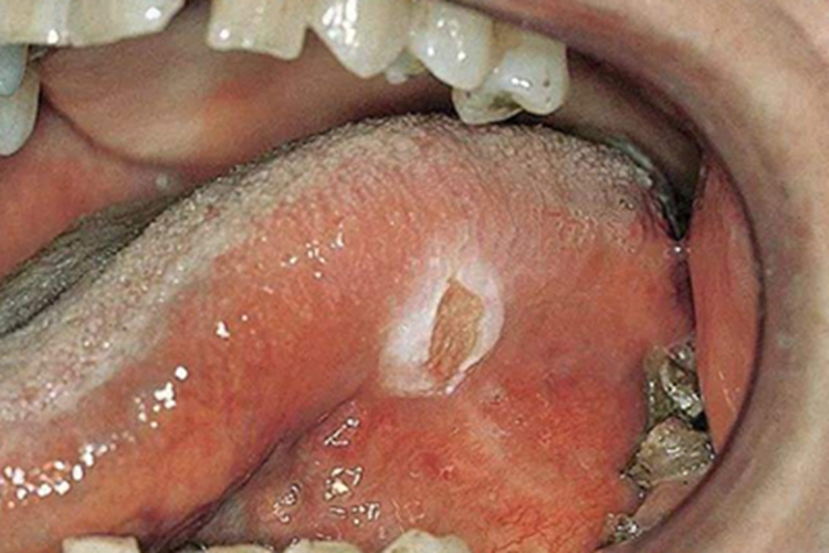 创伤性溃疡症状图 创伤性溃疡症状图