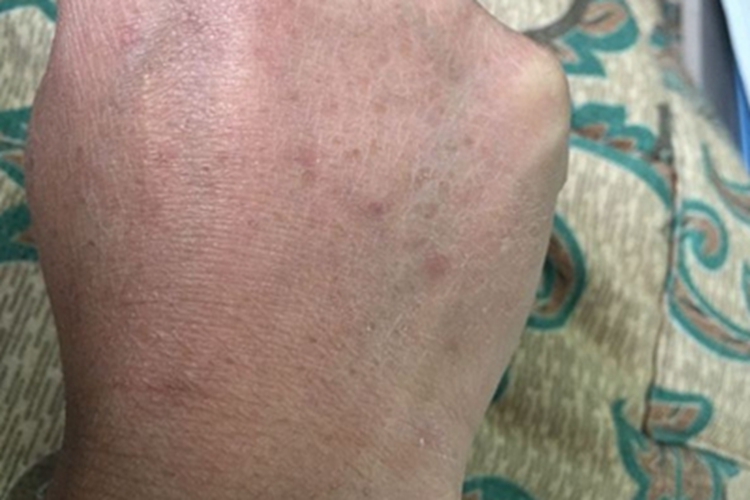 脂溢性角化病手部皮肤粗糙图