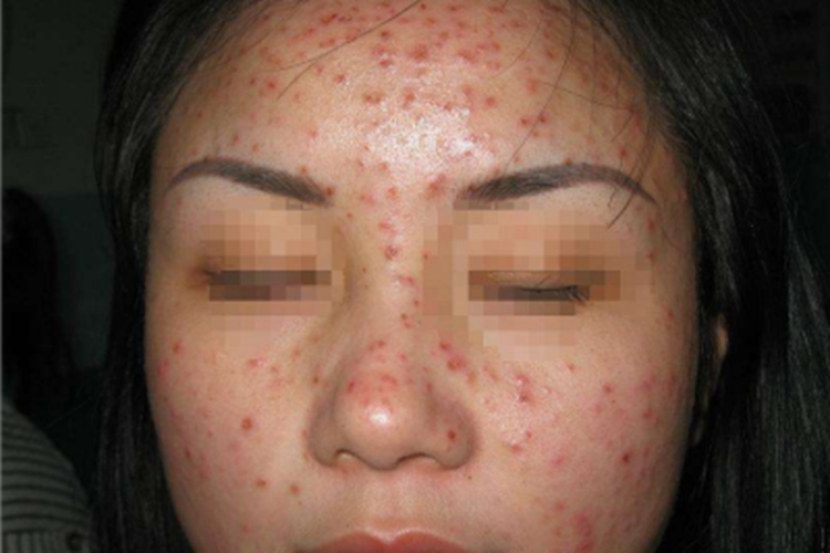 马拉色菌毛囊炎鼻部结痂图