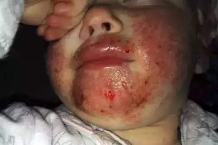 疱疹样天疱疮嘴唇症状图 疱疹样天疱疮嘴唇症状图