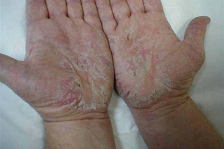 甲状腺功能减退症手掌皮肤增厚图