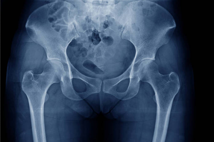 正常髋关节X光片图 正常髋关节X光片图