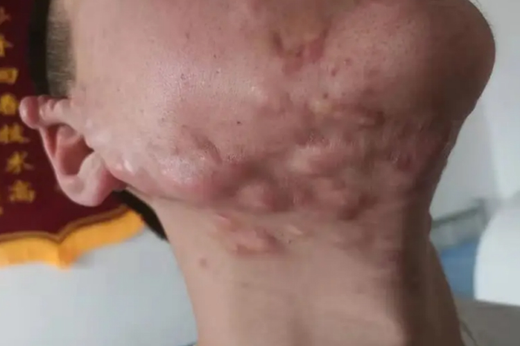 增生性痤疮瘢痕图