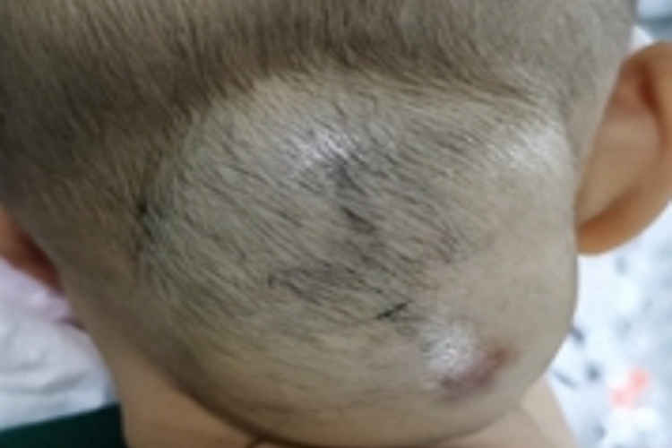 淋巴管瘤大包图