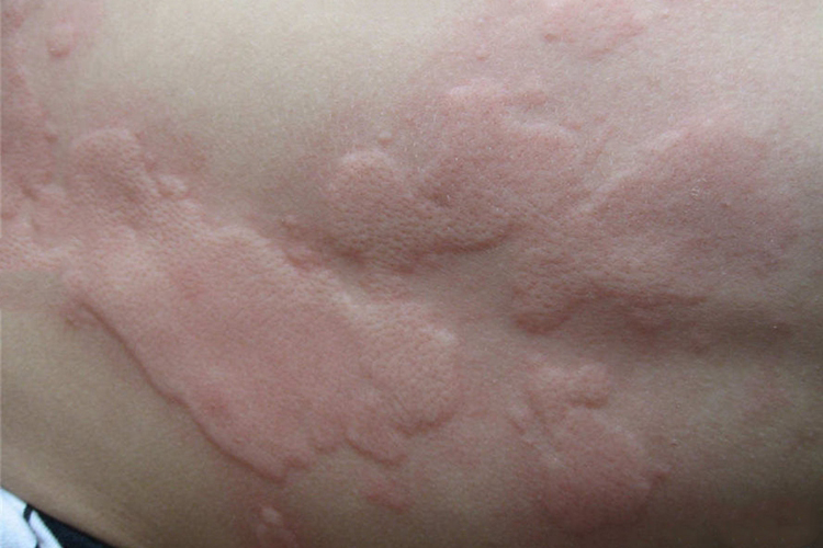 荨麻疹图