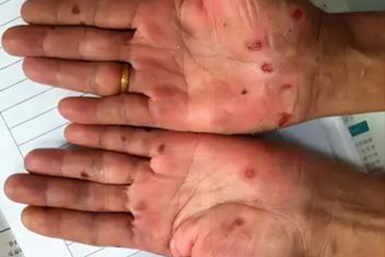 结节性梅毒疹手掌症状图