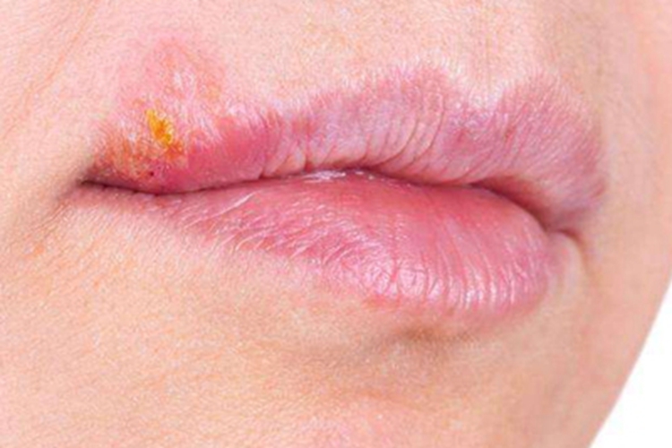 口唇疱疹嘴角黄色结痂图