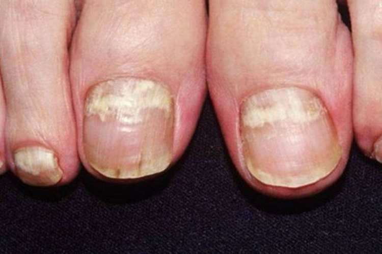 脚近端甲下型甲真菌病图