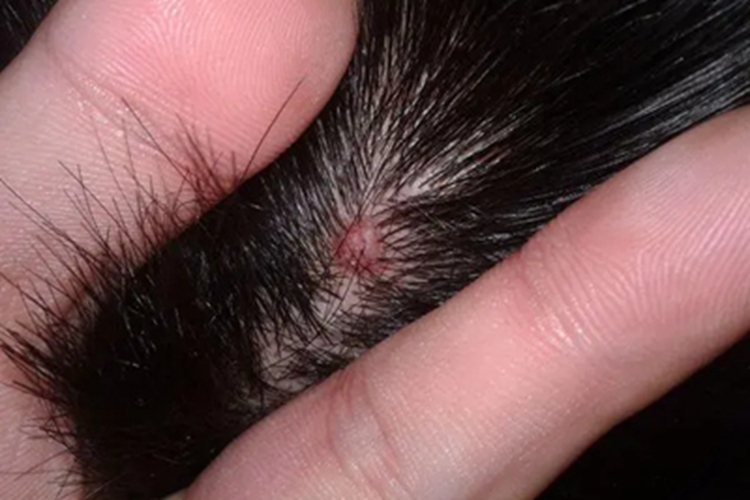 毛囊上皮瘤头皮疙瘩图