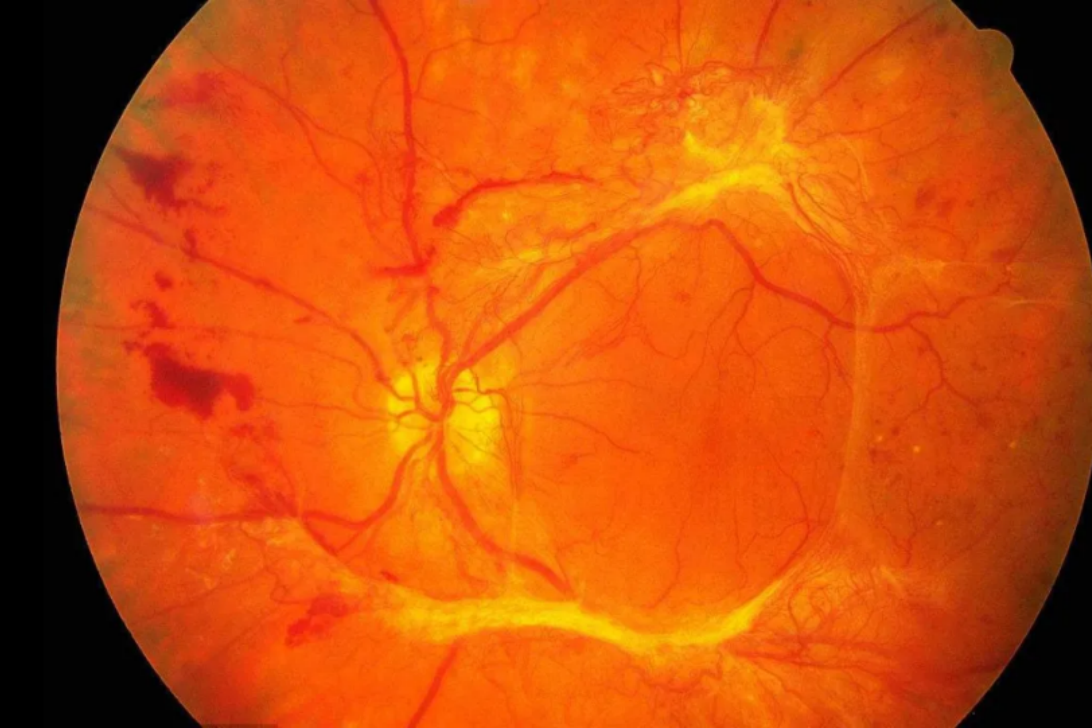 视网膜出血点图糖尿病足:指与下肢远端神经异常和不同程度周围血管