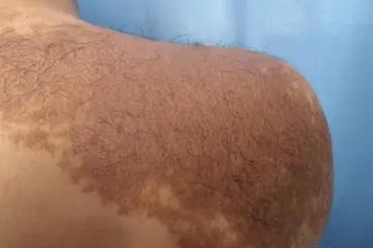 泛发型表皮痣肩部症状图
