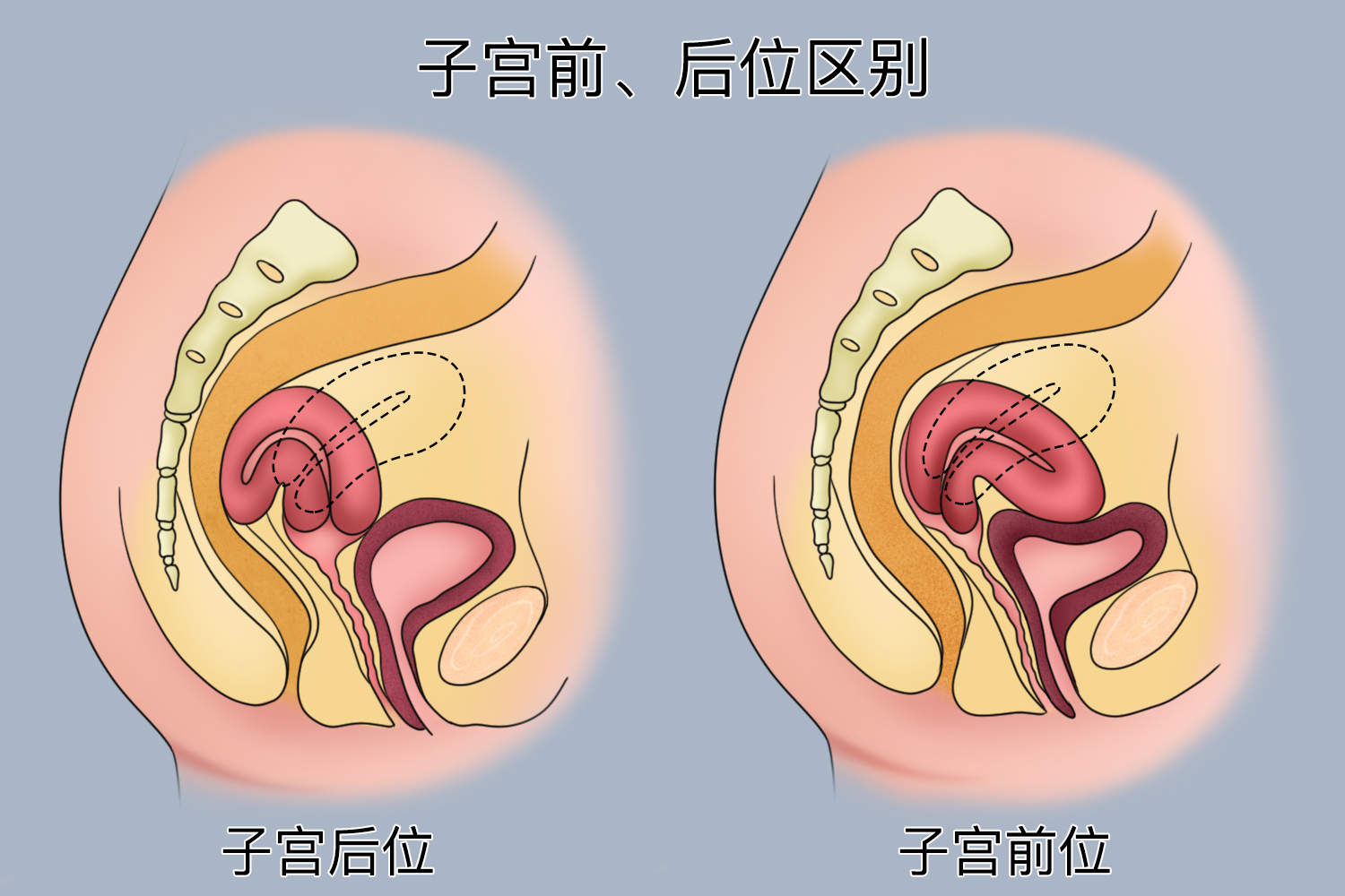 子宫前位和子宫后位区别图 子宫前位和子宫后位区别图