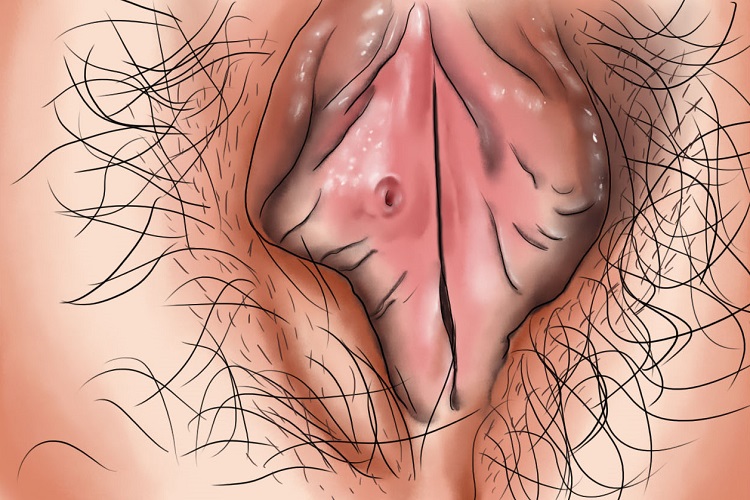 急性外阴溃疡会阴部溃疡手绘图 急性外阴溃疡会阴部溃疡手绘图