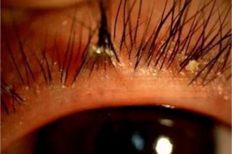 鳞屑性睑缘炎眼睑症状图 鳞屑性睑缘炎眼睑症状图