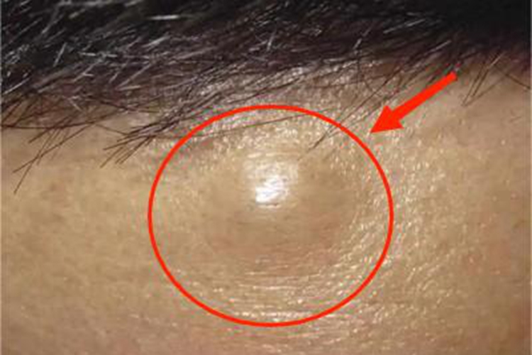 皮样囊肿前额圆疙瘩图