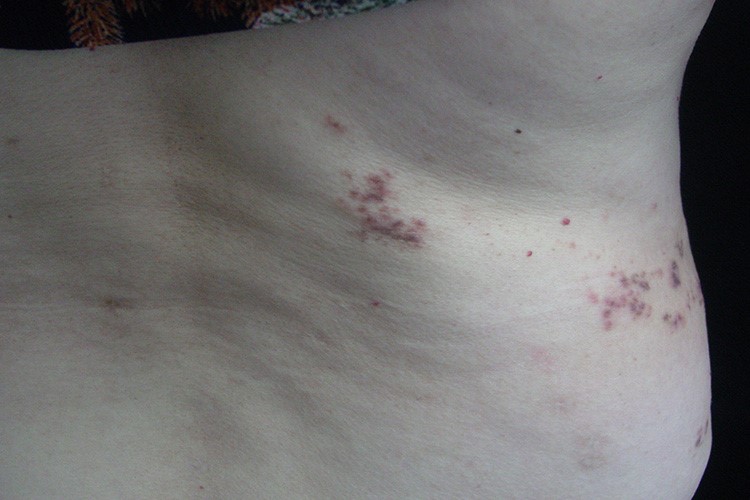 艾滋病腰部带状疱疹图 艾滋病腰部带状疱疹图